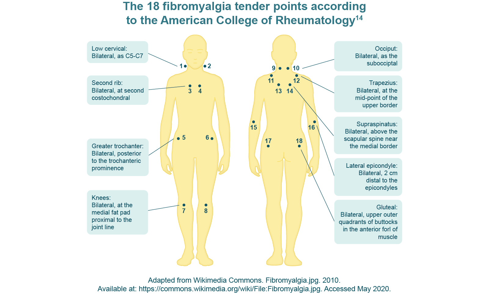 The 18 fibromyalgia tender points according to the american college of rheumatology